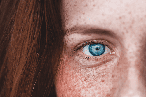 CİLTTEKİ KAHVERENGİ LEKELER